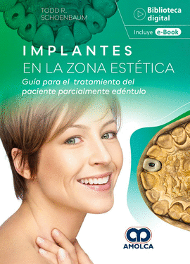 IMPLANTES EN LA ZONA ESTÉTICA. GUÍA PARA EL TRATAMIENTO DEL PACIENTE PARCIALMENTE EDÉNTULO