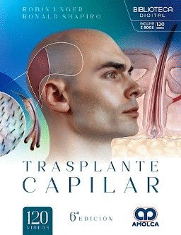 TRASPLANTE CAPILAR