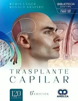 TRASPLANTE CAPILAR