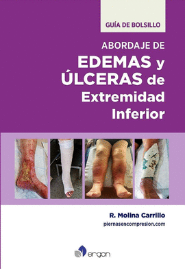 ABORDAJE DE EDEMAS Y ÚLCERAS DE EXTREMIDAD INFERIOR