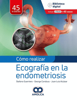 CÓMO REALIZAR ECOGRAFÍA EN LA ENDOMETRIOSIS