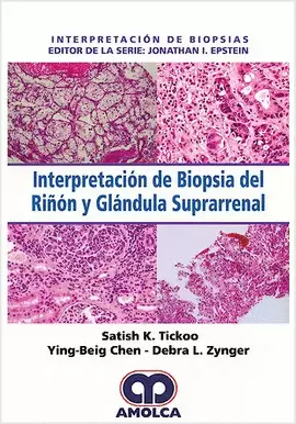 INTERPRETACIÓN DE BIOPSIA DEL RIÑÓN Y GLÁNDULA SUPRARRENAL PPTX