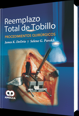 REEMPLAZO TOTAL DE TOBILLO - PROCEDIMIENTOS QUIRURGICOS