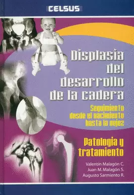 DISPLASIA DEL DESARROLLO DE LA CADERA