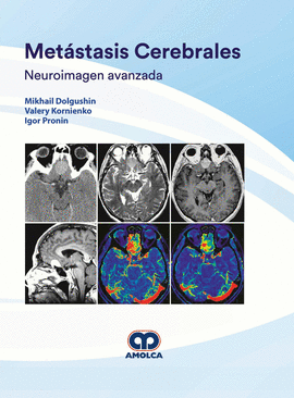 METASTASIS CEREBRALES NEUROIMAGEN AVANZADA