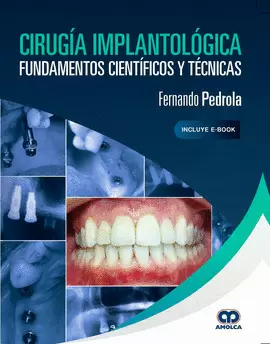 CIRUGIA IMPLANTOLOGICA FUNDAMENTOS