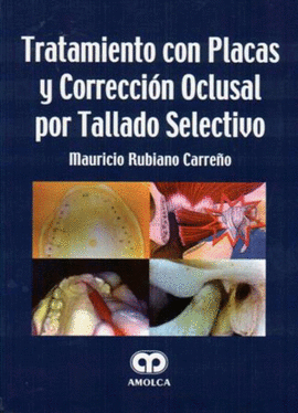 TRATAMIENTO CON PLACAS Y CORRECCIÓN OCLUSAL POR TALLADO SELECTIVO